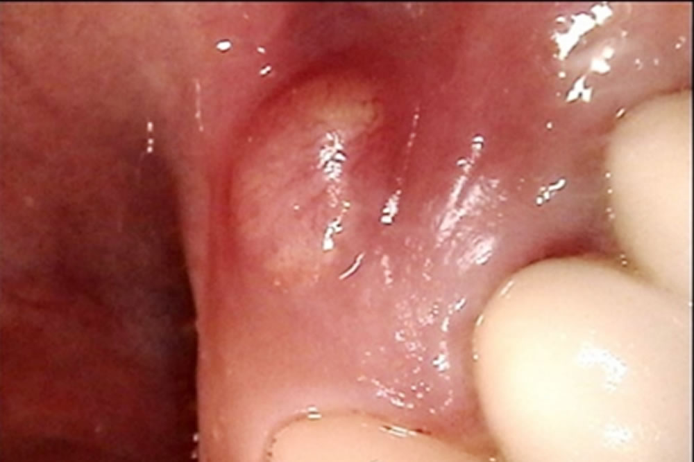 歯茎の腫れたブリッジの土台の歯を根管治療で改善した症例